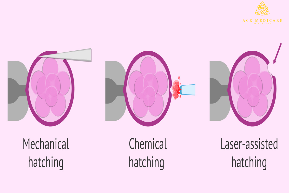 The Role of Laser-Assisted Hatching in Improving IVF Success Rates